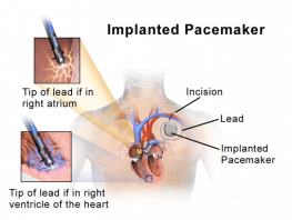 Pacemaker Insertion Surgery - Indications, Procedure and Safety ...