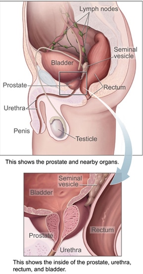 Radical prostatectomy surgery prostate